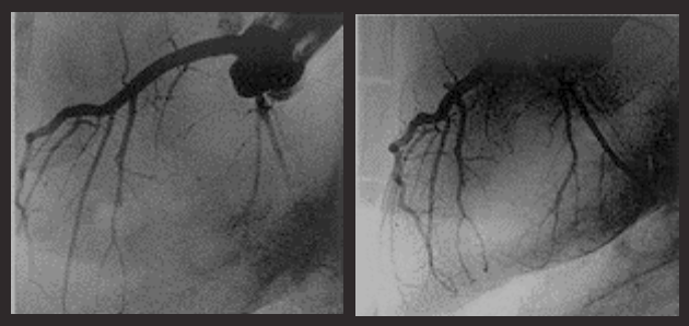 ภาพ X-Ray ก่อนและหลังรักษาด้วย Shockwave
