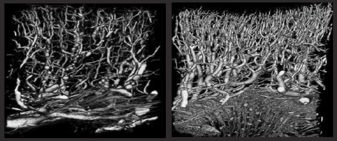 ภาพ X-Ray ก่อนและหลังรักษาด้วย Shockwave